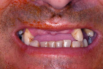 ESTÉTICA BUCAL COM PRÓTESE
